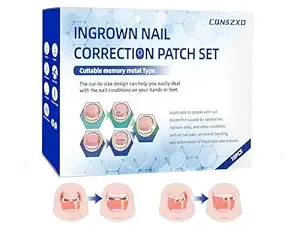 Customizable Memory Alloy Ingrown Toenail Treatment Patch, 10 PCS Home Ingrown Toenail Corrector, Designed for Curved and Multi-Size Nails Ingrown Toenail Removal Kit, Nail Repair for Finger and Foot