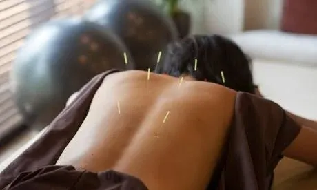 Dallas Acupuncture Healing Session